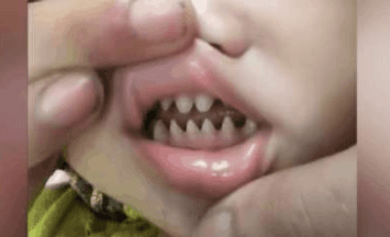 孩子嘴裡長出尖銳「鯊魚齒」父母覺得超霸氣 醫生:害了他
